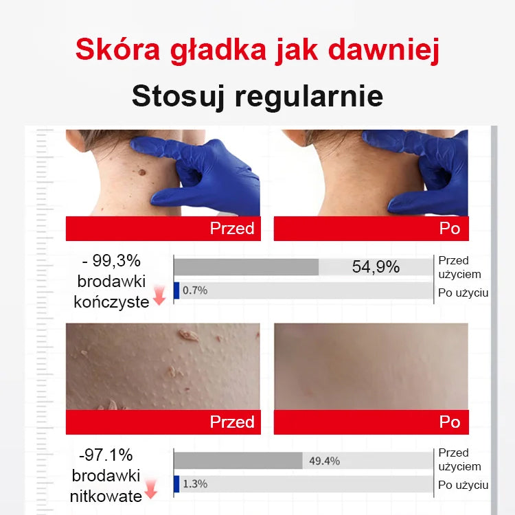 Szybko Działający Krem na Brodawki – Widoczne Efekty