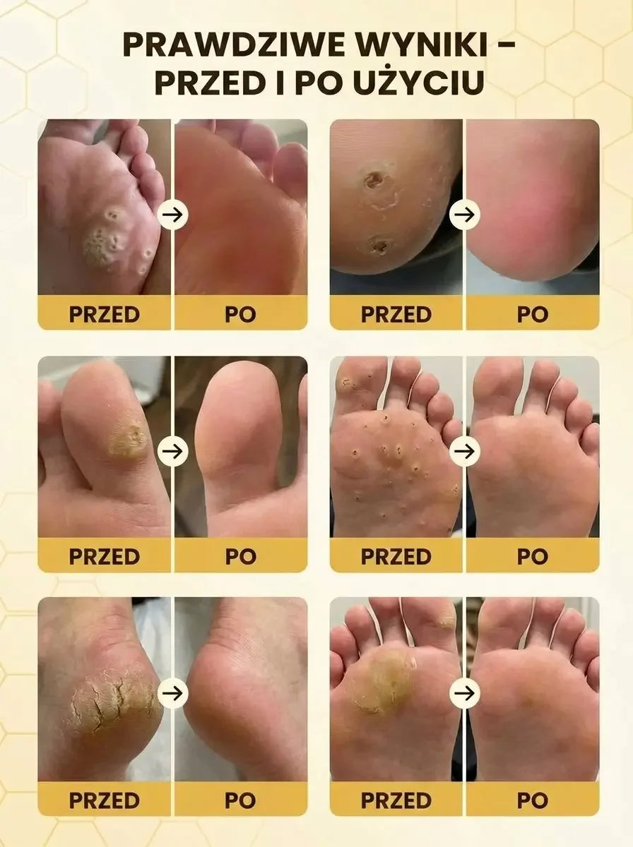 Krem na Odciski i Modzele z Jadem Pszczelim